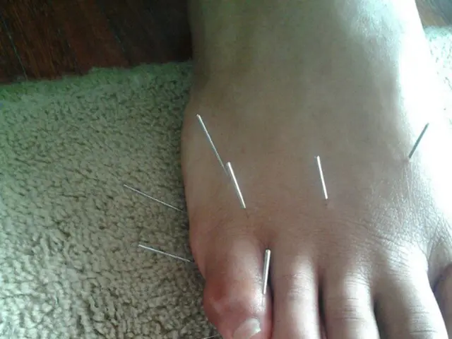 Lifesaving Intervention: Endovascular Stent Grafting for a Rare Superior Mesenteric Vein Erosion in...